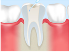 根管内の消毒