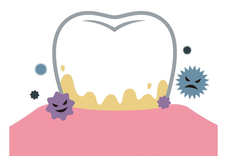 歯周病になる原因
