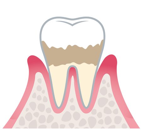 軽度歯周病