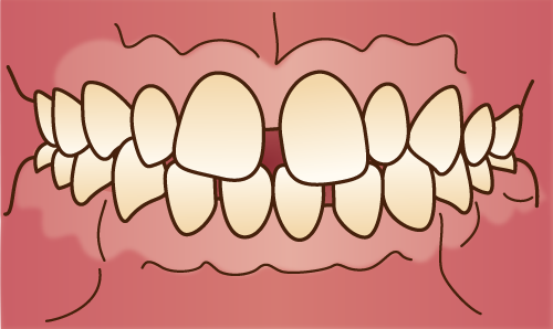空隙歯列・正中離開(すきっ歯)