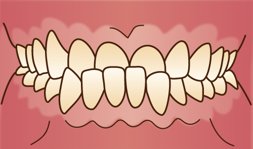 下顎前突・反対咬合(受け口)