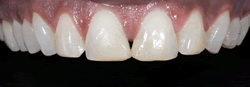 歯の隙間（歯の大きさ）の改善